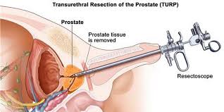 Dapatkan informasi dan perawatan yang tepat di mount elizabeth hospitals. Begini Deteksi Dini Cegah Kanker Prostat Okezone Lifestyle