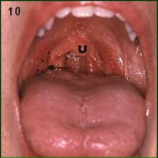 Image result for tonsilla palatina