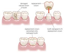 Is crown better than filling? Dental Crown Procedure Healthdirect