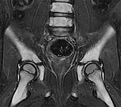 Contribute to m14t/backbone development by creating an account on github. Mr Imaging Of Pediatric Bone Marrow Radiographics