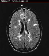 But abnormal mri results do not always mean that you have ms. Pin On Multiple Sclerosis