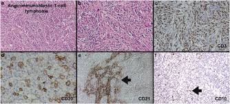 It is one of the. Cd10 Expression In Peripheral T Cell Lymphomas Complicated By A Proliferation Of Large B Cells Modern Pathology