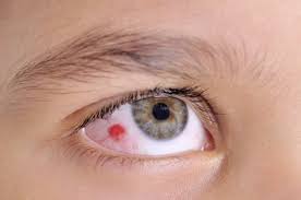 Has Tenido Un Derrame En Un Ojo