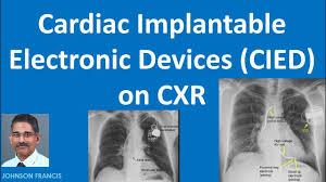 It also contains a computer that tracks your heart rate and rhythm. Cardiac Implantable Electronic Devices Cied On Cxr