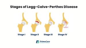 Image result for Perthes Test