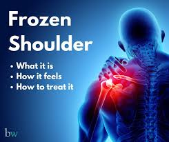 Image result for Frozen Shoulder