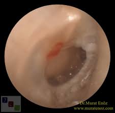 Eardrum Repair Without Ear Packing Pureregen Gel Otol