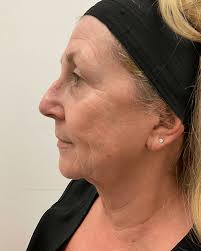 Case 100528 – Ultherapy