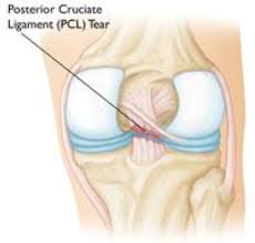 They're often caused by ligament damage. Common Knee Injuries Orthoinfo Aaos