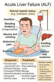Infographic on acute liver failure: patient in hospital bed with symptoms, diagnosis, treatment, and common causes