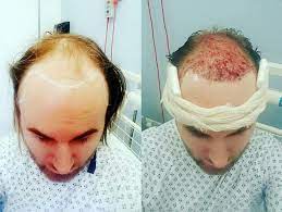 Being aware of your hair's health and its growth pattern is the first step to getting ahead of hair loss. Man Going Bald In 20s Was So Self Conscious He Didn T Have Sex For Three Years But That S All Changed Now Mirror Online