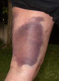 These groups of muscles are particularly susceptible to injury due to their anatomic arrangement. Hamstring Strain What Is It What Can I Do About It Physioroom Blog