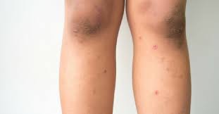 Ingrown hairs are common in parts of the body where hair is removed frequently. Pin On Ingrown Hair Solution