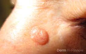 It&#x27;s important to know the main risk factors. Is It Skin Cancer Tumor Identification Friday Pop Quiz 2 15 Next Steps In Dermatology