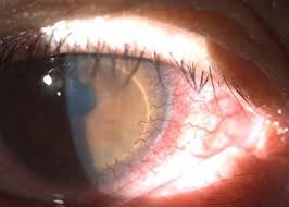 각막에 혈관이 생기다; 각막 신생혈관 : 네이버 블로그