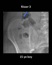 Image result for Risser Sign