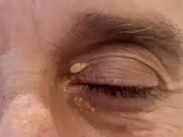 Image result for xantelasma