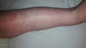 The parts of the skin that are not blotchy may be very pale (this is called pallor). Mottled Skin 2 Year Old