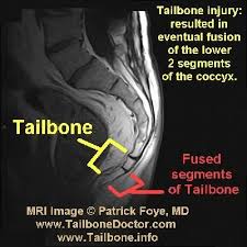 Pin On Tailbone Pain Doctor