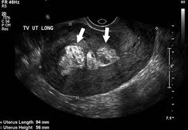 • diagnostic ultrasound, edited by carol m. First Trimester Ultrasound Early Pregnancy Failure First Trimester Ultrasound A Comprehensive Guide