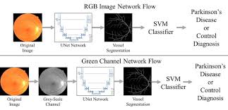 Making an accurate diagnosis of parkinson's — particularly in its early stages — is difficult, but a skilled practitioner can come to a reasoned conclusion that it is pd. Eye Exam Could Lead To Early Parkinson S Disease Diagnosis Axis Imaging News