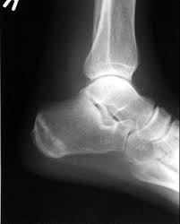 If the foot or shin pain is focused on one area and becomes constant or worse during a run, then you should see a. Radiology Quiz 11970 Radiopaedia Orgviewing Playlist Fractures For Gp Registrars Radiopaedia Org