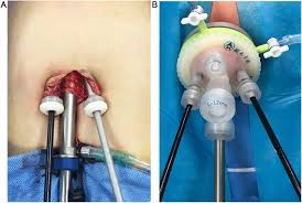 There are two main types of cancer of the cervix women who have had a total hysterectomy (removal of the uterus and cervix) should also stop having cervical cancer screening, unless they have a history of cervical. Chopstick Technique Used In Laparoendoscopic Single Site Radical Hysterectomy For Early Stage Cervical Cancer Scientific Reports