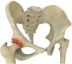 Hip Arthritis Cheshire | Degenerative Joint Disease Staffordshire