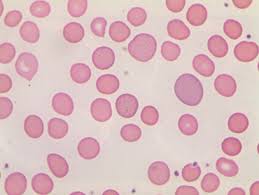 Treatment for iron deficiency consists. Anemia Knowledge Amboss