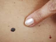Typischerweise bilden sich vulgäre warzen im gesicht, an den fingern und unter der nagelplatte. Vulgare Warzen Stachelwarzen Erkennen Und Behandeln