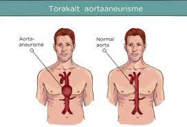 Har hatt smerter i nedre del av magen, venstre side siste sommeren 2011. Eldre Mann Med Sterke Smerter I Magen Pa Venstre Side Kare Nesheim Kommentarer Til Forstehjelpscase 28