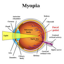 People with a high degree of nearsightedness or farsightedness along with astigmatism have less predictable results. Lasik Surgery In Delhi Best Laser Eye Treatment Doctor Hospital Cost