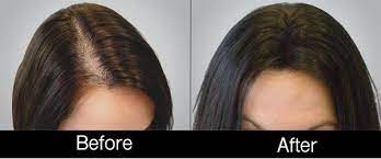 We describe the intradermal injections of a recombinant, bioengineered hair formulation, containing growth factors, into the scalp skin, for enhancement of hair regrowth and evaluate its efficacy. Vijay Kumar Medium
