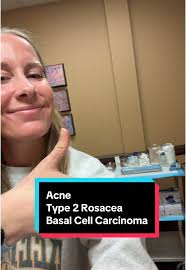 Understanding Skin Issues: Acne and Skin Cancer Awareness