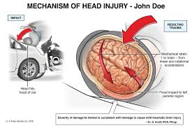 Image result for Brain Contusion
