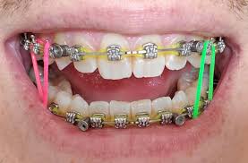 How to put rubber bands on braces. How To Stain Powerchains Braces