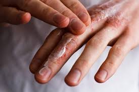Image result for Ichthyosis