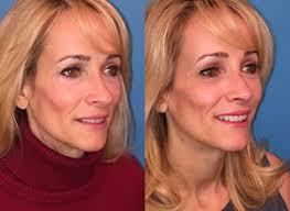 Barry M. Weintraub, MD, FACS, Board Certified Plastic Surgeon