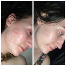 Bioelements Skin Care