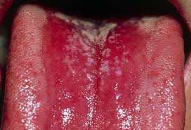 Thrush Caused By Candida Yeast Thrush Is Most Common In Older Adults Or Babies But A Weakened Im Yeast Infection Treatment Yeast Infection Geographic Tongue