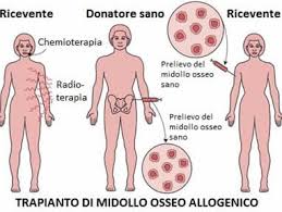 Le cellule della leucemia possono causare sintomi intasando i vasi sanguigni, accumulandosi in vari organi e diffondendosi alla pelle, alle gengive, al cervello o al midollo spinale. Trapianto Di Midollo Osseo