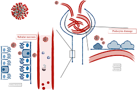 This content is provided as a service of the national institute of diabetes and digestive and kidney diseases (niddk), part of the national institutes of health. Renal Involvement In Covid 19 A Review Of The Literature Idr