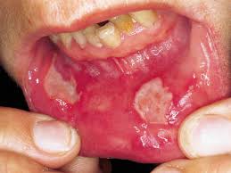 Image result for Aphthasol