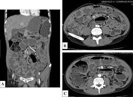 Celiac Disease Do Not Miss That Diagnosis Sciencedirect