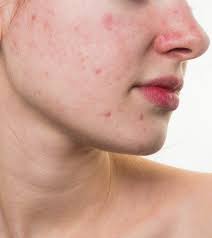 There are many products for dark spots in the market, but they aren't all created equal. How To Get Rid Of Red Spots On Face 6 Home Remedies And Tips