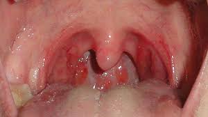 Sore Throat Treatment Causes Diagnosis Symptoms More