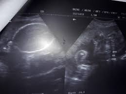 الاسبوع السادس من الحمل عالم حواء. Ø³ÙˆÙ†Ø§Ø± Ø§Ù„Ø¨Ù†Øª ÙÙŠ Ø§Ù„Ø´Ù‡Ø± Ø§Ù„Ø³Ø§Ø¨Ø¹