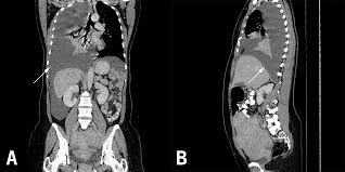 Thoracic endometriosis can be identified using different methods such as; Wbxg3yxoqxmpfm