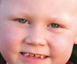 Inspiring spina bifida story