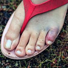 A broken toe healing time is usually around 6 weeks, which means your job during that time is to do all the things that are going to help you come back strong. Broken Toe Fractures Treatment Buddy Taping Symptoms Healing Time